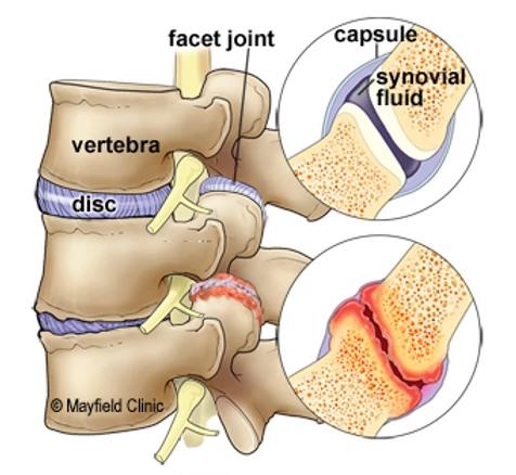 What causes lower back pain?